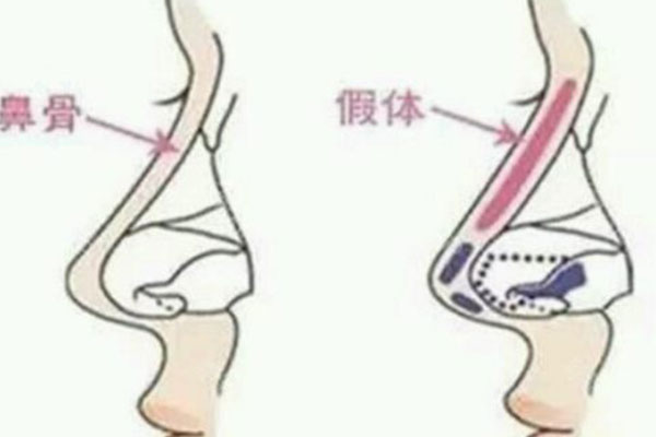假体隆鼻示意图