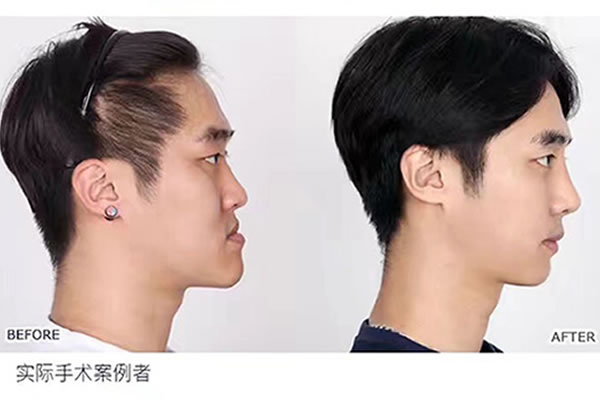 82整形男鞋拔子脸手术.jpg