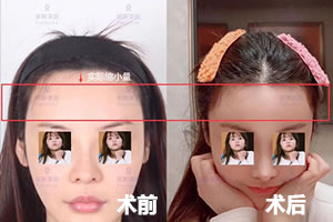 韩国菲斯莱茵SMART额头缩小术案例.jpg