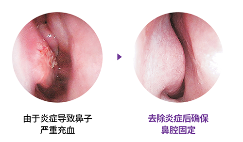 韩国原辰功能性鼻整形效果