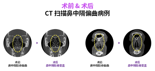 原辰功能性鼻整形改善鼻中隔偏曲前后效果