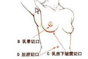 假体隆胸到底选择什么样的切口
