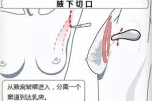 腋窝切口