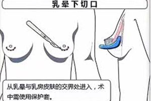 乳房下皱襞切口