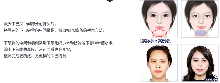 下巴手术.png