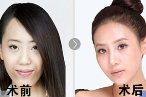 韩国菲斯莱茵双颚+轮廓手术案例.jpg