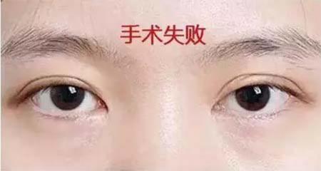 双眼皮失败展示