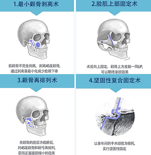 韩国菲斯莱茵整形医院颧骨手术过程