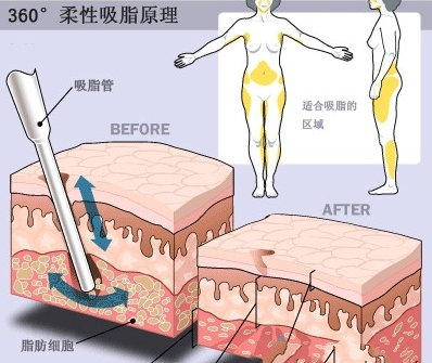 360度环吸原理