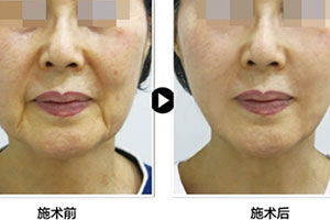 韩国普罗菲耳朴明旭院长面部提升案例