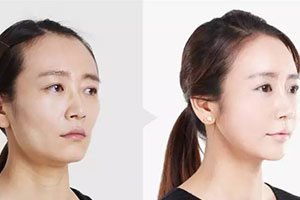 韩国TL整形医院郑渊豪院长面部提升案例
