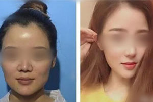 韩国纯真整形医院崔宰源院长面部提升案例