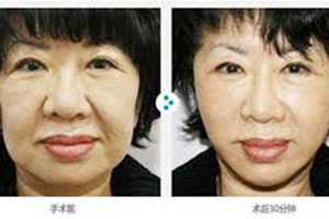 韩国美来可Miracle整形医院禹政浩院长面部提升案例