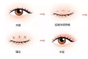 埋线双眼皮
