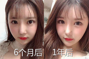 韩国菲斯莱茵颧骨内推手术案例恢复对比照.jpg