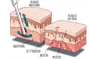 抽脂原理示意图