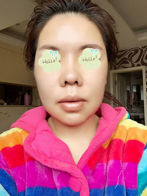 突嘴矫正上下颚和轮廓四件套术后一周恢复照.jpg