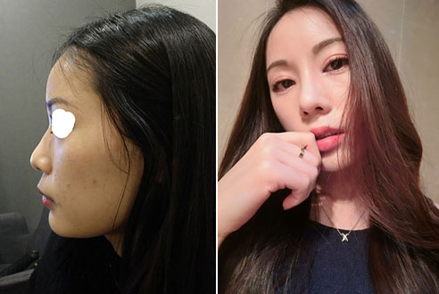 韩国普瑞美整形医院隆鼻真人案例