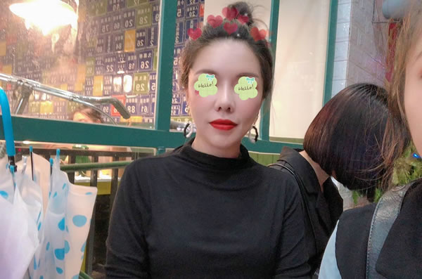 突嘴矫正上下颚和轮廓四件套术后半年恢复照.jpg