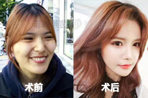 韩国菲斯莱茵面部轮廓整形术前术后对比.jpg