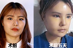 韩国菲斯莱茵面部轮廓术后恢复.jpg