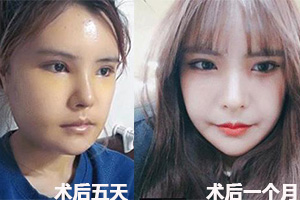 韩国菲斯莱茵面部轮廓手术后一个月.jpg