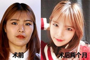 韩国菲斯莱茵面部轮廓恢复情况.jpg