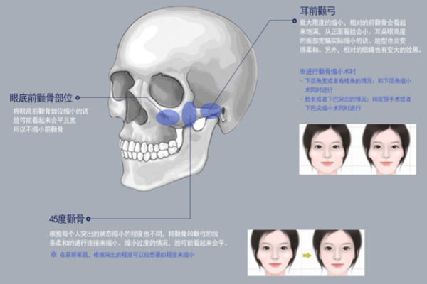 韩国菲斯莱茵颧骨缩小术.jpg