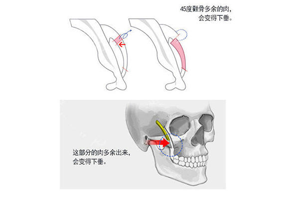 韩国菲斯莱茵颧骨缩小术手术方法.jpg