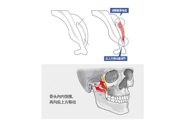韩国菲斯莱茵颧骨缩小术手术方式.jpg