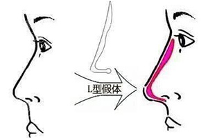 假体隆鼻