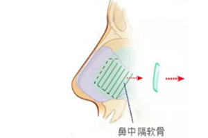 鼻中隔软骨