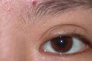 双眼皮过宽