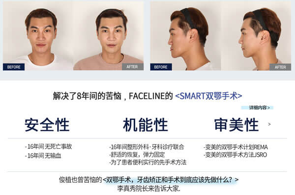 菲斯莱茵男士双颚手术前后对比照.jpg