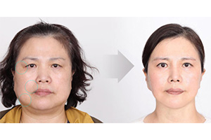 韩国菲斯莱茵迷你拉皮手术案例.jpg