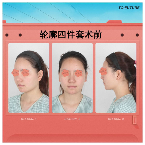菲斯莱茵轮廓四件套术前照.jpg