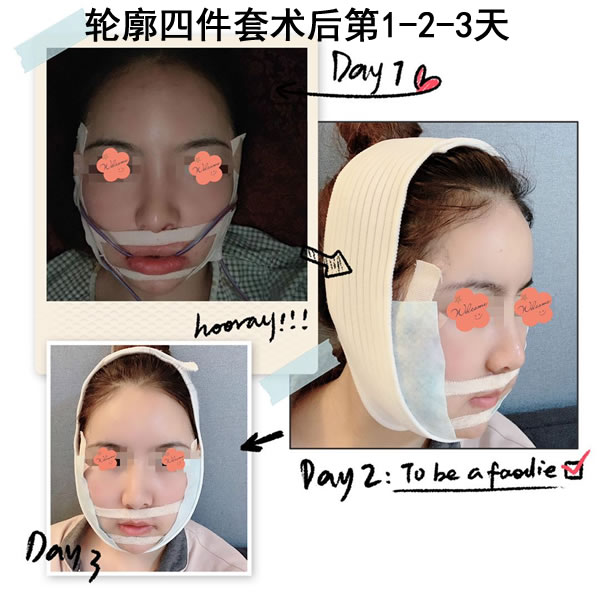 菲斯莱茵轮廓四件套术后3天照片.jpg