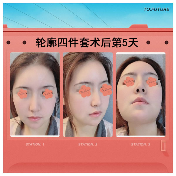 菲斯莱茵轮廓四件套术后5天照.jpg