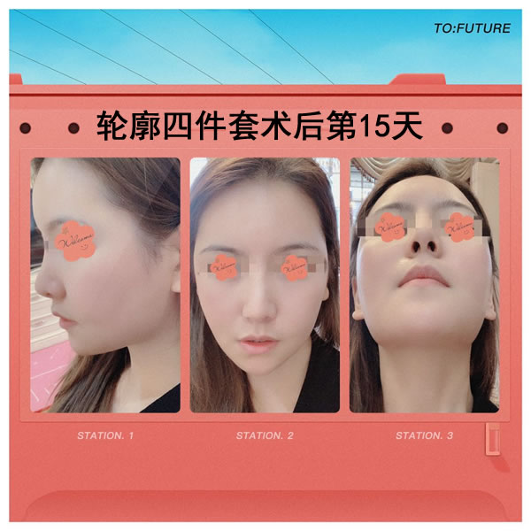 菲斯莱茵轮廓四件套术后15天照.jpg