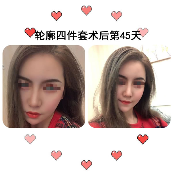 菲斯莱茵轮廓四件套术后45天照.jpg