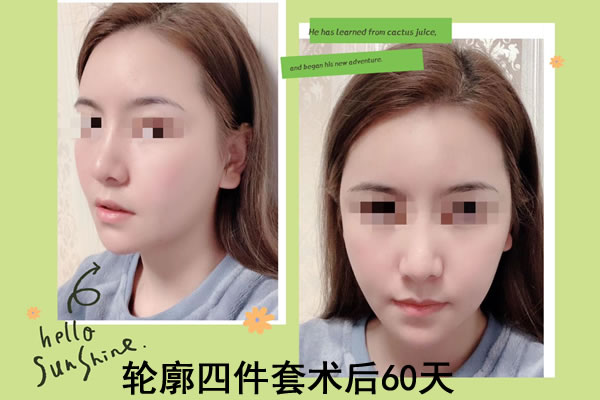 菲斯莱茵轮廓四件套术后60天照.jpg