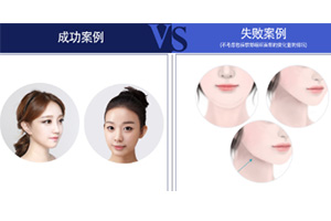 下颌角整形对比图.jpg