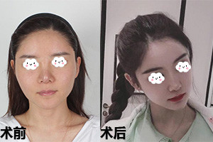 菲斯莱茵下颌角整形案例对比照.jpg