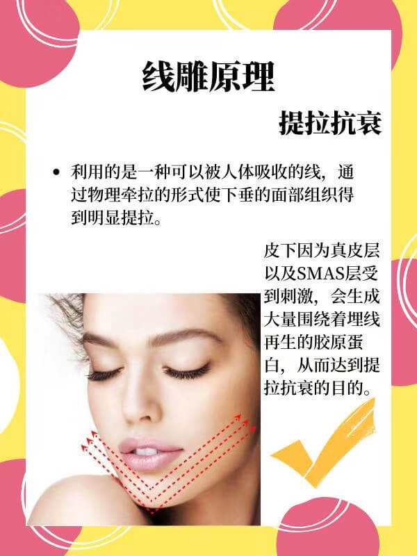 面部提升线雕手术原理.jpg