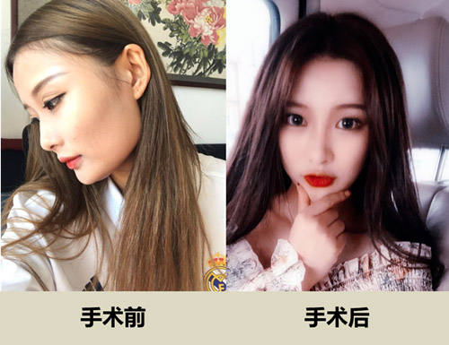 韩国面部轮廓整形案例