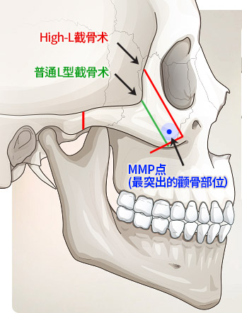 韩国ID整形医院high-L颧骨内推