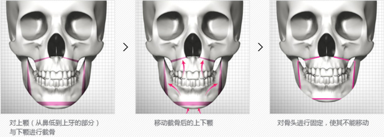 原辰双鄂手术