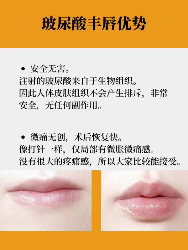 玻尿酸丰唇优势.jpg