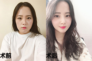 韩国菲斯莱茵面部轮廓手术案例对比图.jpg