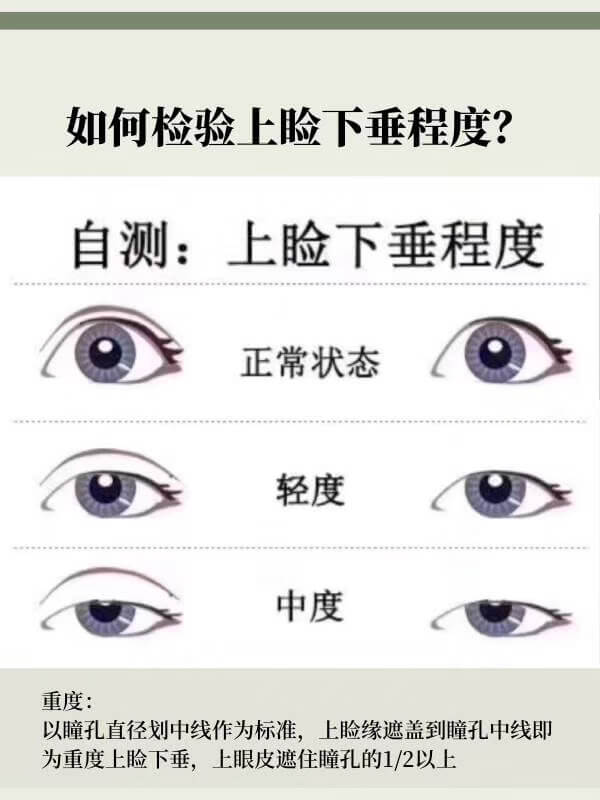 如何检验自己上睑下垂的程度.jpg